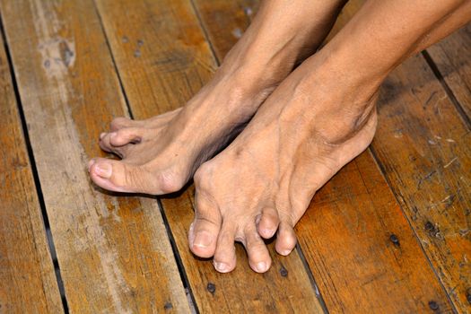 Old woman's foot deformed from rheumatoid or gout arthritis