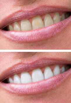 close up of woman teeth bleaching treatment, before and after.