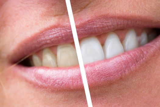 close up of woman teeth bleaching treatment, before and after.