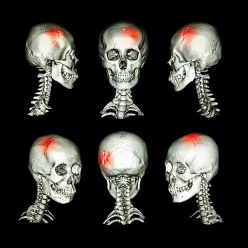 CT scan and 3D image of head and cervical spine . Use this image for stroke , skull fracture , neurological condition .