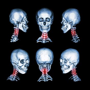 CT scan and 3D image of skull and neck . Use this image for cervical spondylosis , spondylolisthesis , spondylitis , spine trauma condition .