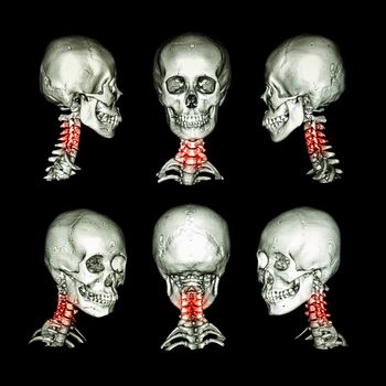 CT scan and 3D image of skull and neck . Use this image for cervical spondylosis , spondylolisthesis , spondylitis , spine trauma condition .