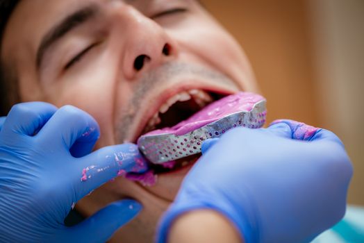 Dentist using dental impression for braces to the male patient. Close-up. Real people.