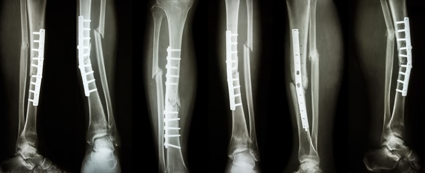 Collection image of leg fracture and surgical treatment by internal fixation with plate and screw . Break tibia and fibula bone .