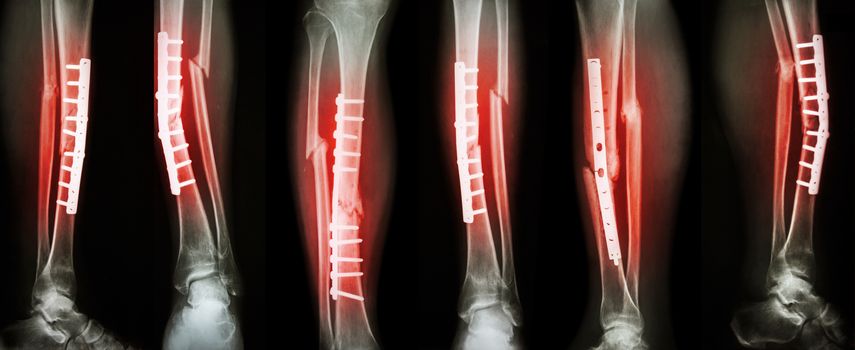 Collection image of leg fracture and surgical treatment by internal fixation with plate and screw . Break tibia and fibula bone .