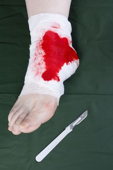 White medicine bandage on human injury foot