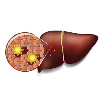 Medical illustration of healthy liver cells attacked by toxins