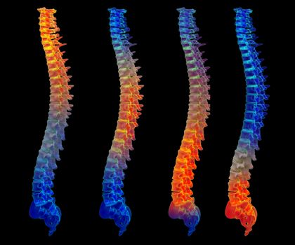 3d rendering painful spine
