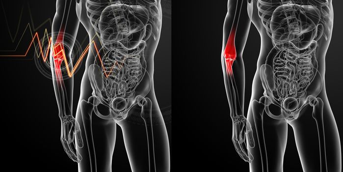 3d render medical illustration of the arm pain