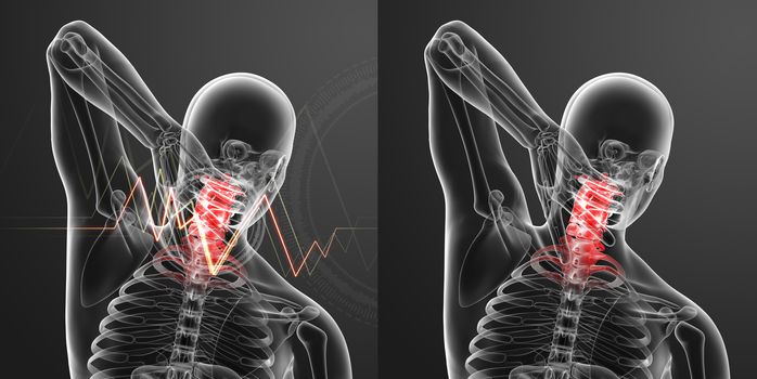 3d rendered illustration - pain neck