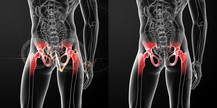 3D rendering medical illustration of a painful hip joint 