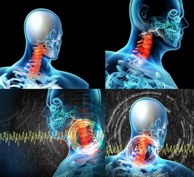 3d rendered illustration - painful neck