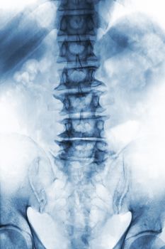 Spondylosis . film x-ray lumbosacral spine of old aged patient show osteophyte , collapse spine from degenerative process . Front view .