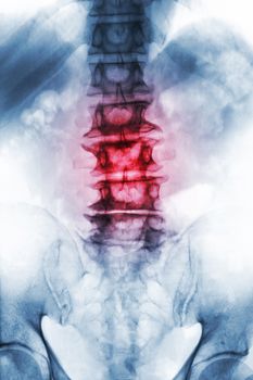 Spondylosis . film x-ray lumbosacral spine of old aged patient show osteophyte , collapse spine from degenerative process . Front view .