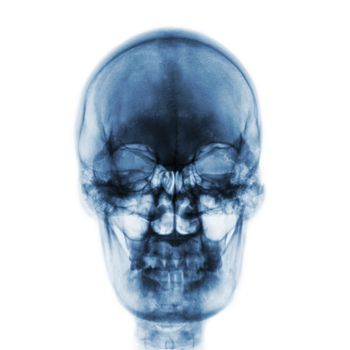 Film x-ray of normal human skull on isolated background . Front view .