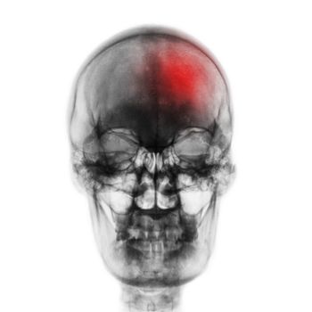 Stroke ( Cerebrovascular accident ) . Film x-ray skull of human with red area . Front view .