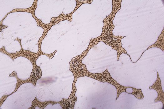 Congealed blood cells under the microscope.