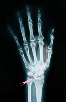 Human Left hand on device x ray - Medical Image