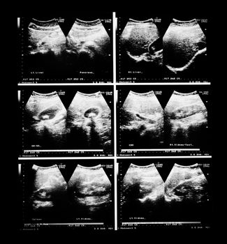 sonography upper abdomen medical examination for healthcare