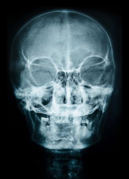 X ray of skull human.