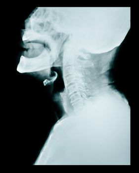 X ray of a neck, cervical.