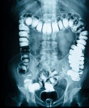 "Small intestine obstruction" Film X-ray abdomen supine