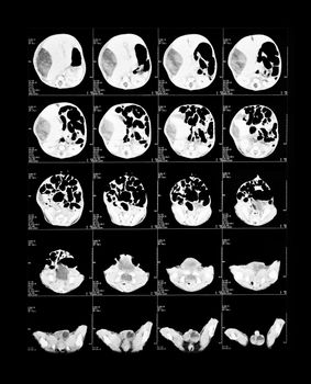 X-ray image of the brain computed tomography (brain)