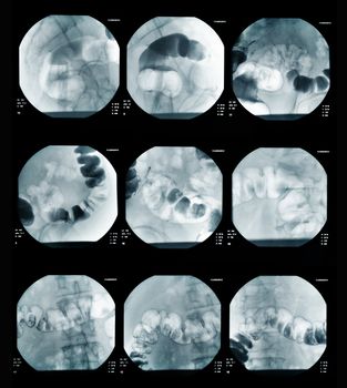 picture of intestinal abdominal xray