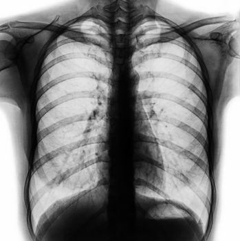 Film chest x-ray PA upright show normal human chest .