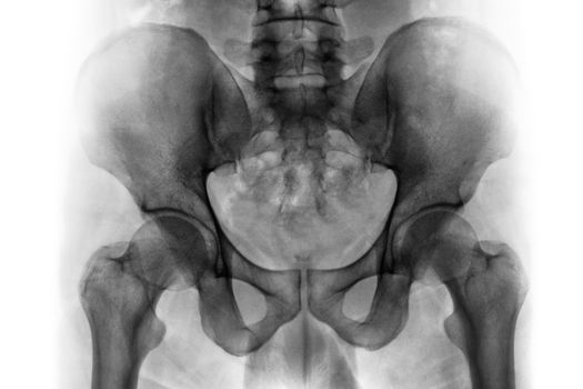 Film x-ray of normal human pelvis and hip joints .