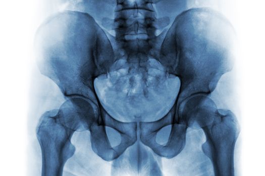 Film x-ray of normal human pelvis and hip joints .