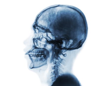 X-ray normal skull and cervical spine . Lateral view . Invert color style .