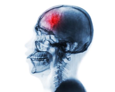 Stroke . Cerebrovascular accident . Film x-ray of human skull and cervical spine .