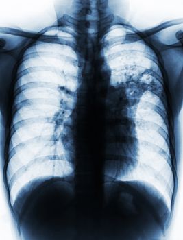 Pulmonary Tuberculosis . Film chest x-ray show alveolar infiltrate at left middle lung due to Mycobacterium tuberculosis infection .