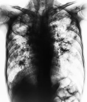Pulmonary Tuberculosis . Film chest x-ray show fibrosis,cavity,interstitial infiltration both lung due to Mycobacterium tuberculosis infection .