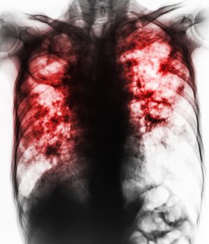 Pulmonary Tuberculosis . Film chest x-ray show fibrosis,cavity,interstitial infiltration both lung due to Mycobacterium tuberculosis infection .