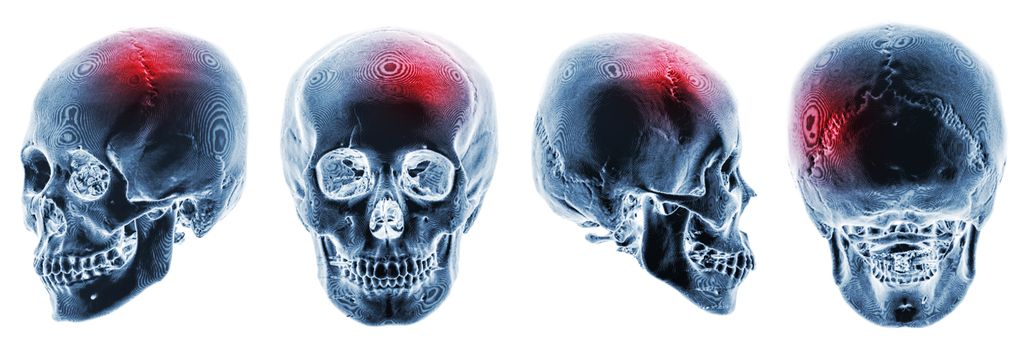 Stroke . Cerebrovascular accident . 3D CT scan of human skull . Multiple view . Invert color style .