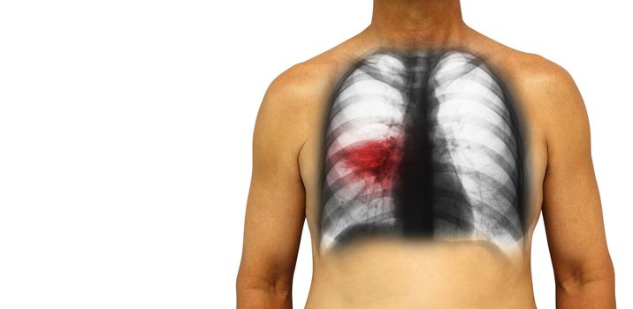 Pulmonary tuberculosis . Human chest with x-ray show patchy infiltrate at right lung due to infection . Isolated background . Blank area at Left side .
