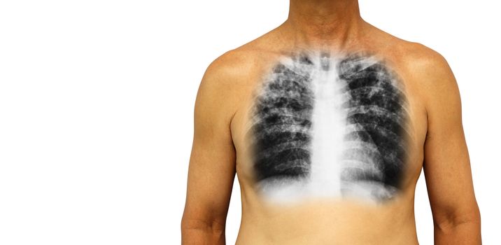 Pulmonary tuberculosis . Human chest with x-ray show interstitial infiltrate both lung due to infection . Isolated background . Blank area at Left side .