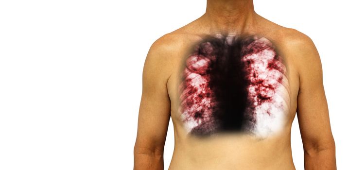 Pulmonary tuberculosis . Human chest with x-ray show cavity at right lung and interstitial infiltrate both lung due to infection . Isolated background . Blank area at Left side .