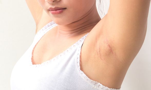 Women problem black armpit for skin care and beauty concept