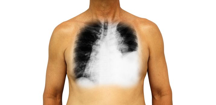 Lung cancer . Human chest and x-ray show pleural effusion left lung due to lung cancer .
