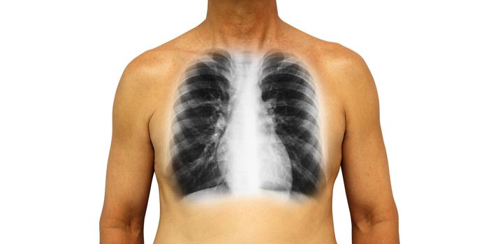 Human chest with x-ray of normal lung . Isolated background .