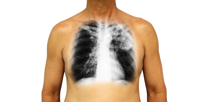 Pulmonary tuberculosis . Human chest with x-ray show patchy infiltrate left upper lung due to infection . Isolated background .