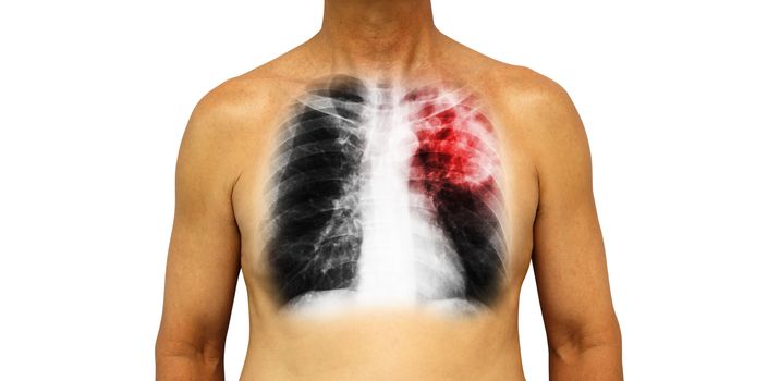 Pulmonary tuberculosis . Human chest with x-ray show patchy infiltrate left upper lung due to infection . Isolated background .