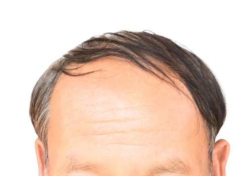 Old man serious hair loss problem for health care shampoo and beauty product concept