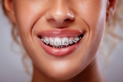 Close-up of a woman white teeth with braces and smile. 