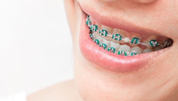 Close up woman smiling with Ceramic and Metal Braces