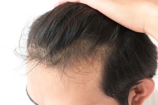 Young man serious hair loss problem for health care shampoo and beauty product concept