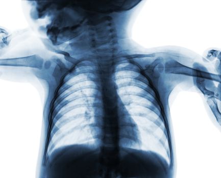 Film chest x-ray of child . isolated background .